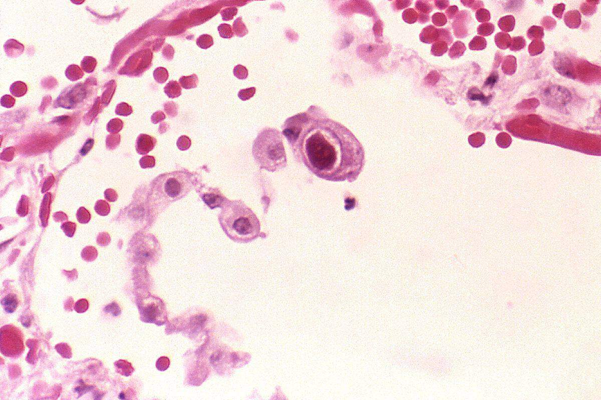 Cytomegalovirus Eulenaugen-Zellen