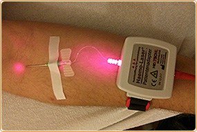 laser-infusion