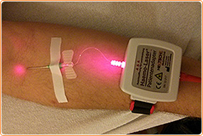 laser infusion
